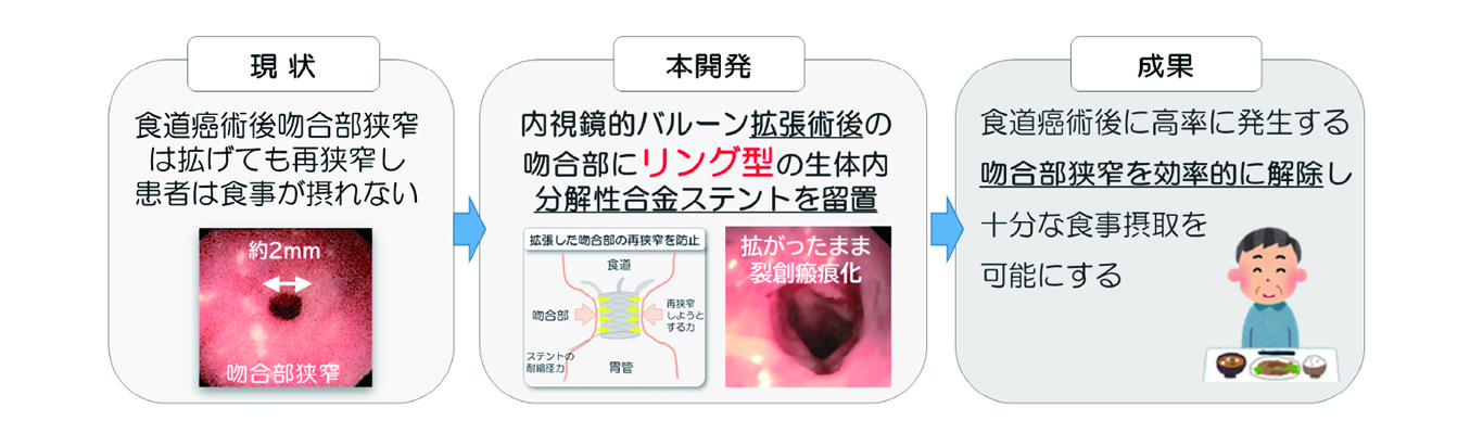 食道癌術後吻合部狭窄を解除する生体内分解性合金ステントの開発